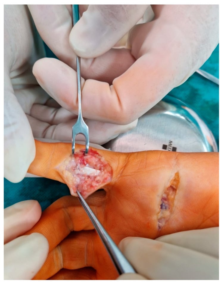 Operative photograph of a volar exposure over the PIP region of the finger, with a second palmar incision proximally.