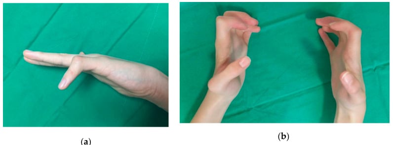 Clinical hand photographs, panels a and b, comparing idiopathic single-digit and syndromic multidigit camptodactyly.