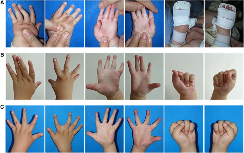 Serial hand photographs, rows A to C, showing progressive-brace correction and later active finger extension and flexion in an infant with distal arthrogryposis.