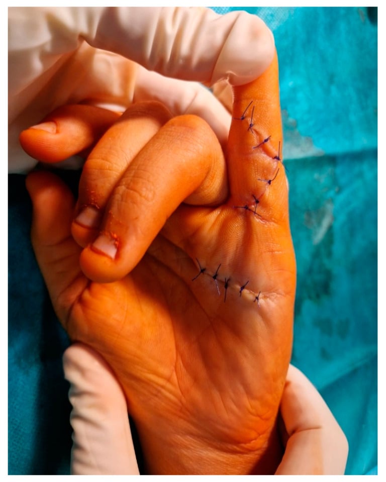 Operative hand photograph showing the operated finger held straight after closure of a zigzag finger incision and a palmar incision.