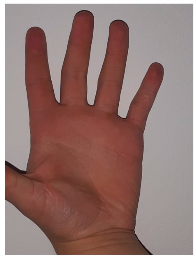 Clinical palm photograph showing maintained finger extension nine months after camptodactyly release.