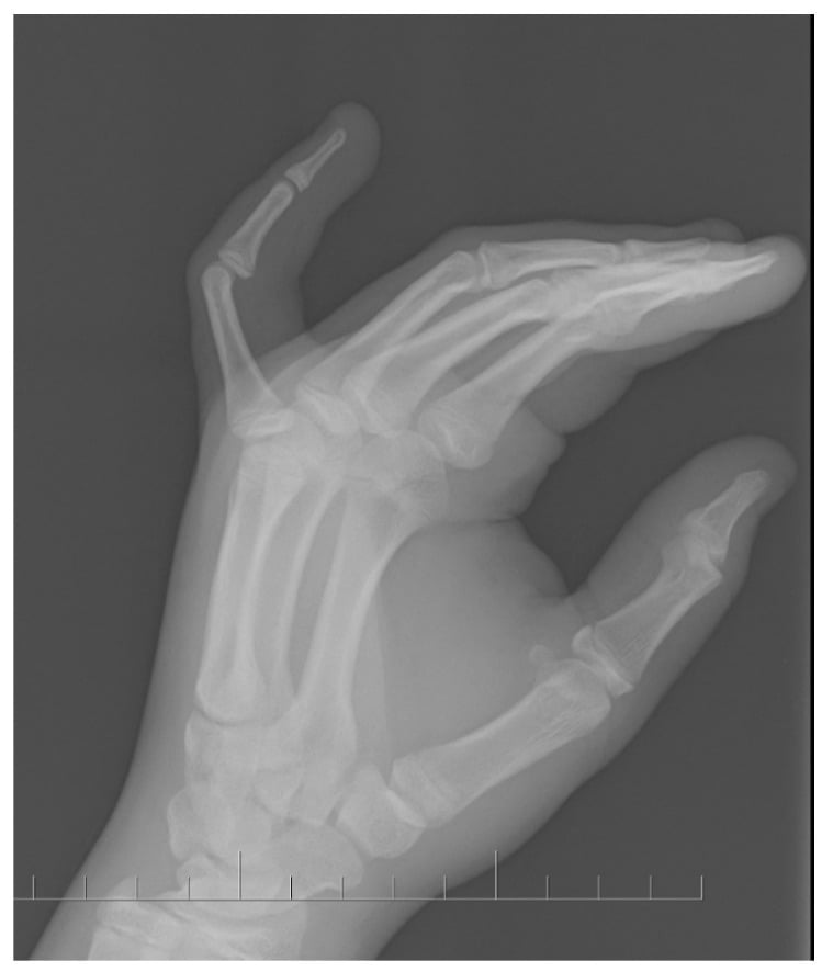 Lateral hand radiograph showing a finger flexion contracture in camptodactyly.