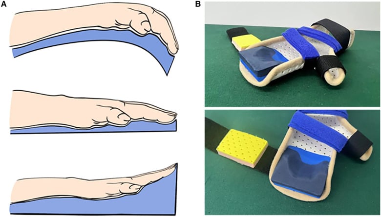Schematic (A) and photographs (B) of a progressive extension brace for distal arthrogryposis camptodactyly.