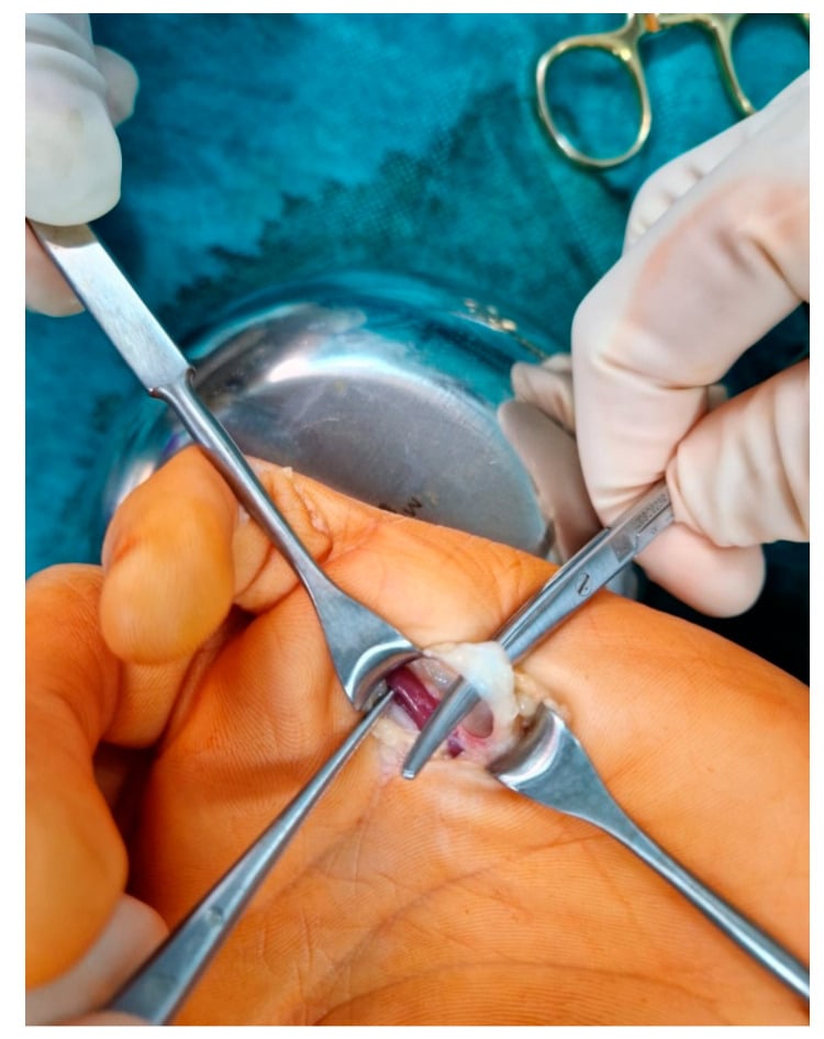 Operative photograph of a tendon lifted on an instrument through a palmar incision during camptodactyly release.