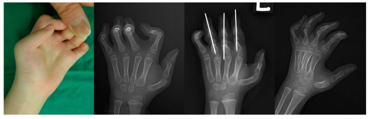 Clinical photograph and three hand radiographs of multidigit camptodactyly in arthrogryposis, one radiograph showing longitudinal wires across the fingers.