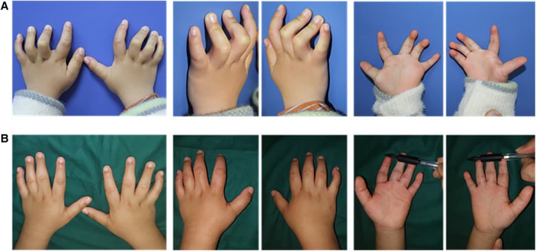 Before-and-after hand photographs, rows A and B, showing correction after eight months of progressive bracing in distal arthrogryposis.