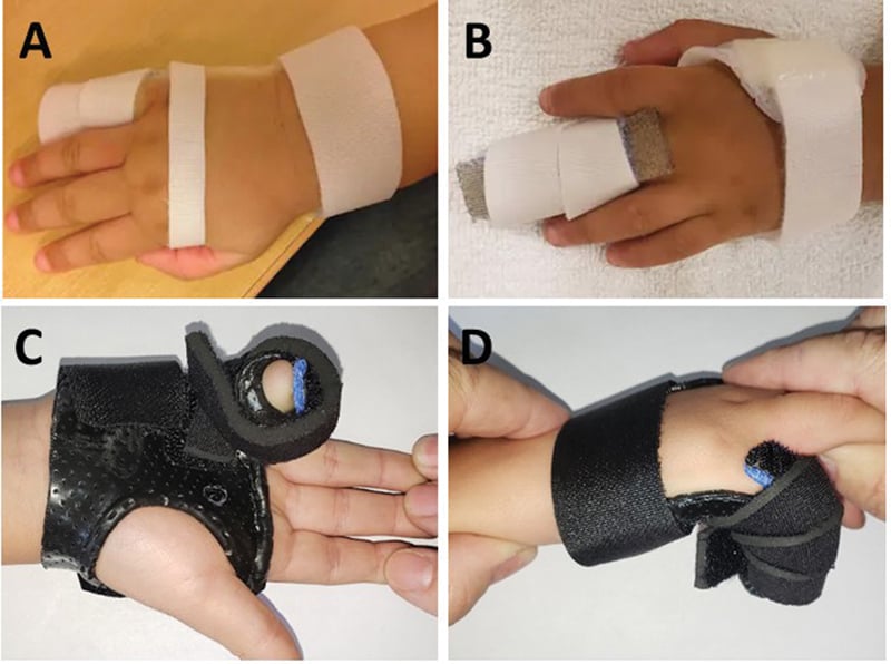 Four static extension orthoses, panels A to D, for flexible and rigid infantile-type camptodactyly.