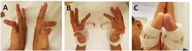 Clinical and orthosis photographs, panels A to C, of rigid bilateral adolescent-type camptodactyly.