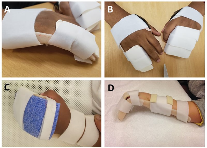 Static orthoses, panels A to D, spanning several fingers for multidigit rigid syndromic camptodactyly.