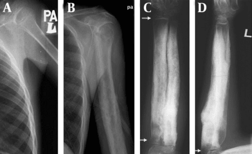 Four-panel radiograph of the shoulder and humeral shaft showing meta-diaphyseal cortical hyperostosis with epiphyseal sparing
