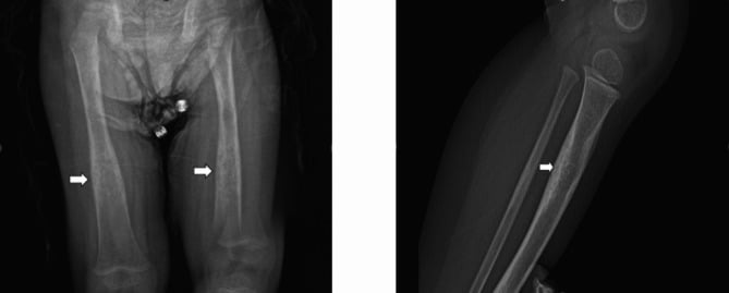 Lower limb radiographs demonstrating bilateral symmetric cortical thickening of femur and tibia