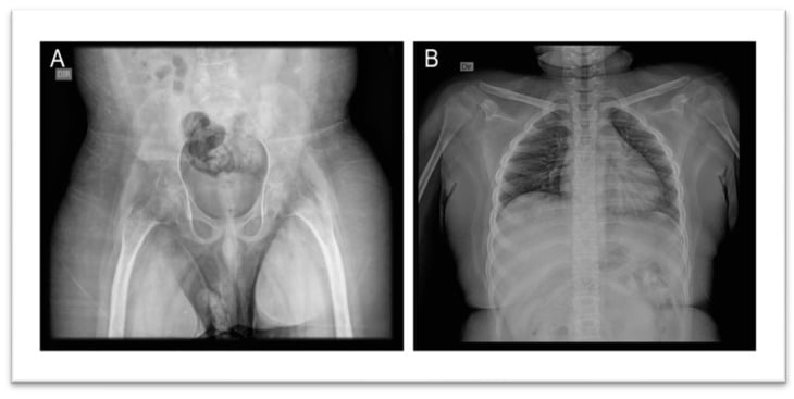 Pelvic radiograph showing cortical hyperostosis and sclerosis in Camurati-Engelmann disease