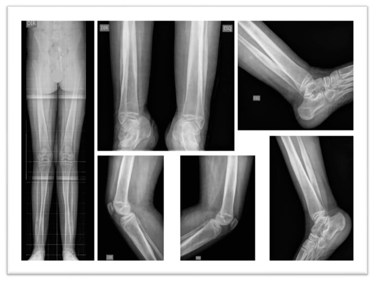 Bilateral lower limb radiographs demonstrating diaphyseal hyperostosis with epiphyseal sparing
