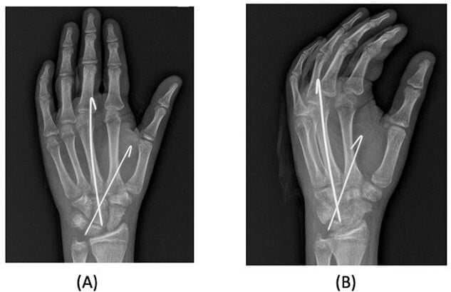 Posteroanterior and oblique wrist radiographs after scaphocapitate fracture fixation