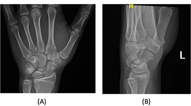 Initial posteroanterior and lateral radiographs of a scaphocapitate wrist injury