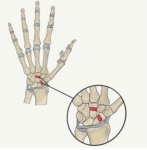Schematic showing scaphocapitate fracture lines through the scaphoid and capitate