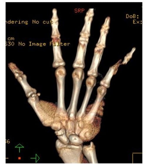 Three-dimensional CT reconstruction of a scaphocapitate fracture
