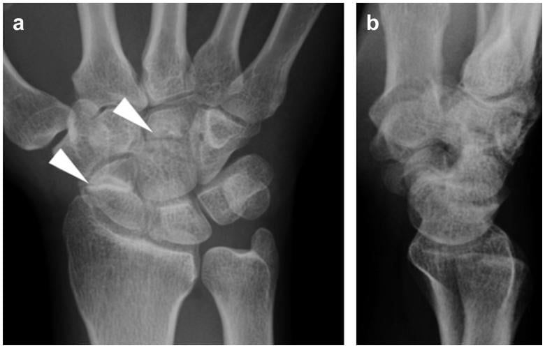 Posteroanterior and lateral radiographs showing scaphoid and capitate non-union