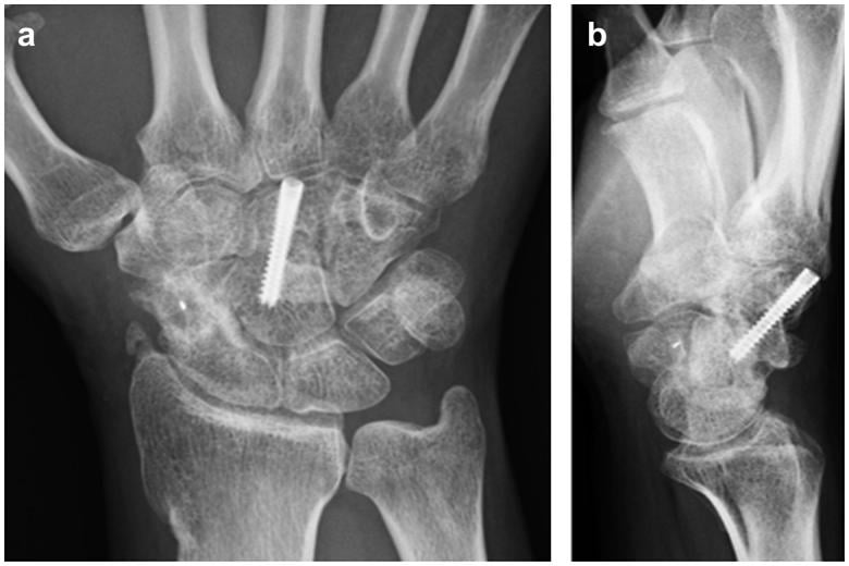 Postoperative radiographs showing healed scaphoid and capitate non-unions