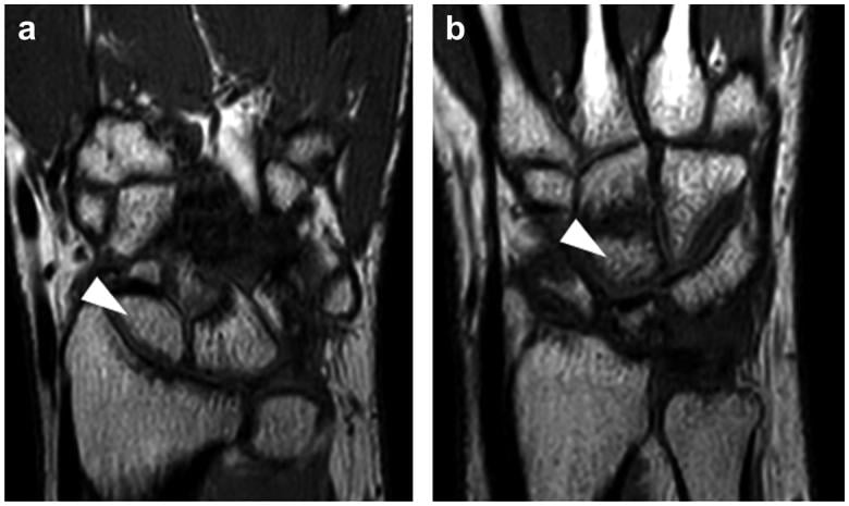 T1-weighted MRI images of scaphoid and capitate non-union
