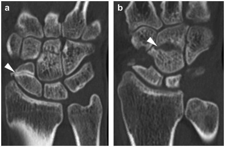 Sagittal CT images showing scaphoid and capitate non-union
