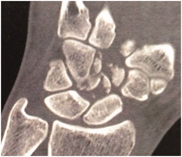 Preoperative CT of a comminuted capitate fracture before resurfacing