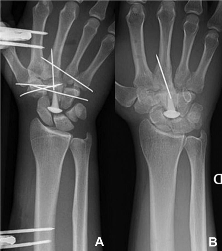 Postoperative and 29-month follow-up radiographs after capitate resurfacing