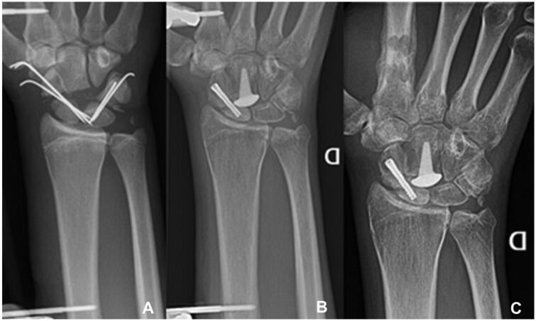 Staged radiographs showing capitate pole loss and pyrocarbon resurfacing