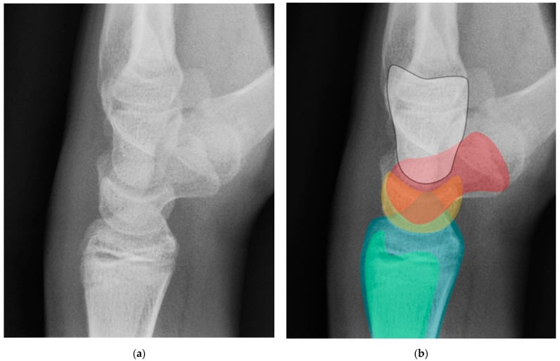 Normal lateral wrist radiograph with colour-coded carpal anatomy overlay