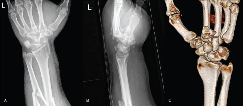 Radiographs and three-dimensional CT of severe carpal fracture-dislocation
