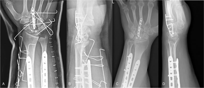 Postoperative radiographs after fixation of a pancarpal dissociation with capitate fixation