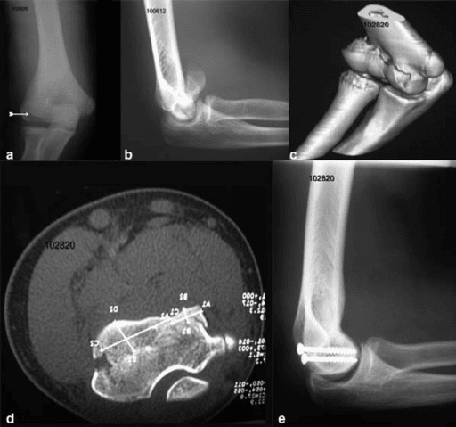 Type 4 capitellum fracture comprehensive imaging with X-ray, 3D CT, and post-operative fixation