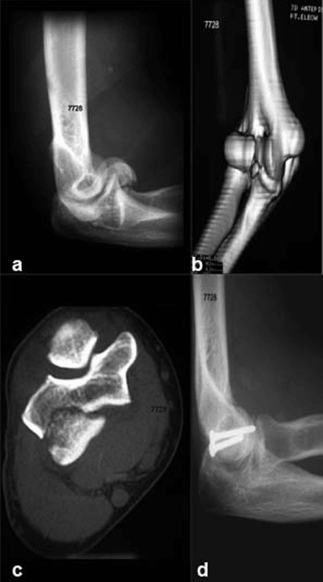 Type 4 capitellum fracture case showing double arc sign and surgical outcome