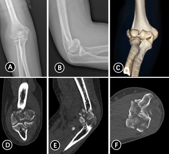 Preoperative radiographs, three-dimensional reconstruction and axial, sagittal and coronal CT of a Dubberley type IIIB distal humerus fracture