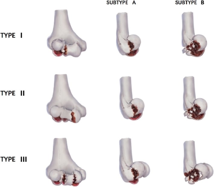 Three-dimensional models showing Dubberley types I, II and III capitellar and trochlear fractures each divided into subtypes A and B