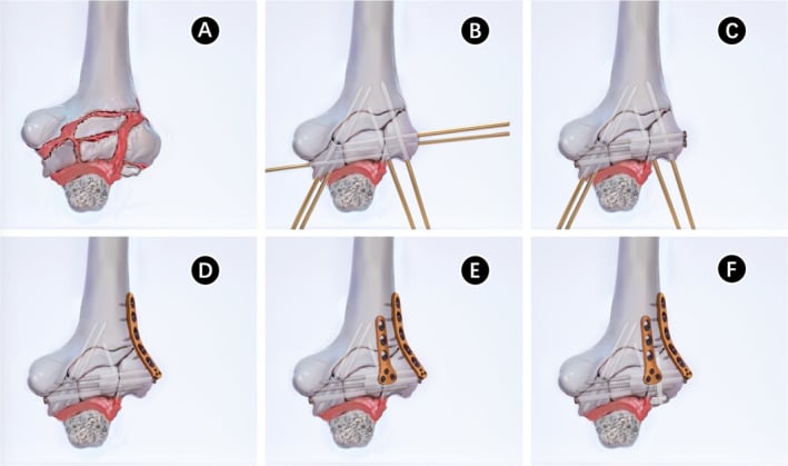 Six-panel operative diagram showing exposure after olecranon osteotomy, provisional Kirschner wire fixation, countersunk screw placement and final plating