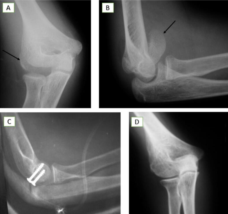 Anteroposterior and lateral radiographs showing a displaced anterior capitellar shear fragment at the radiohumeral joint with postoperative screw fixation views
