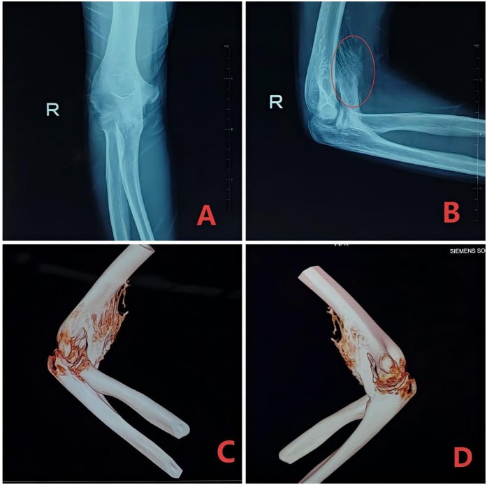 Anteroposterior and lateral radiographs with three-dimensional CT reconstructions showing heterotopic ossification adjacent to the coronoid process with preserved joint space