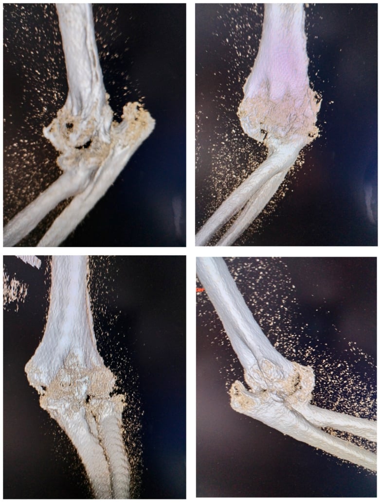 Three-dimensional CT reconstructions showing joint dislocation with massive heterotopic bone occupying the elbow joint
