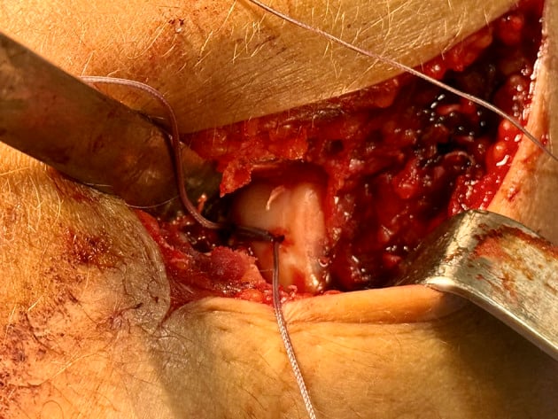 Final intraoperative view of a restored capitellar articular surface held by a knotless suture bridge