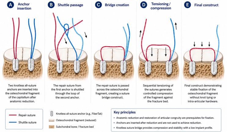 Five-stage schematic of knotless all-suture anchor fixation: anchor insertion, shuttle passage, bridge creation, sequential tensioning and the final low-profile construct