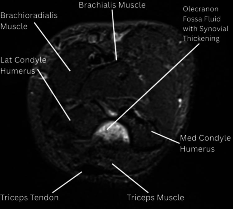 Axial proton density fat-suppressed MRI of the elbow labelling brachialis, brachioradialis, triceps and both condyles with fluid in the olecranon fossa