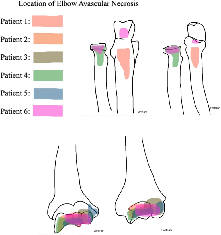 Diagram mapping the location of avascular necrosis on the anterior and posterior distal humerus for six patients