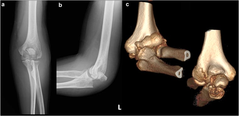 Anteroposterior radiograph, lateral radiograph and three-dimensional CT reconstruction of a capitellar fracture