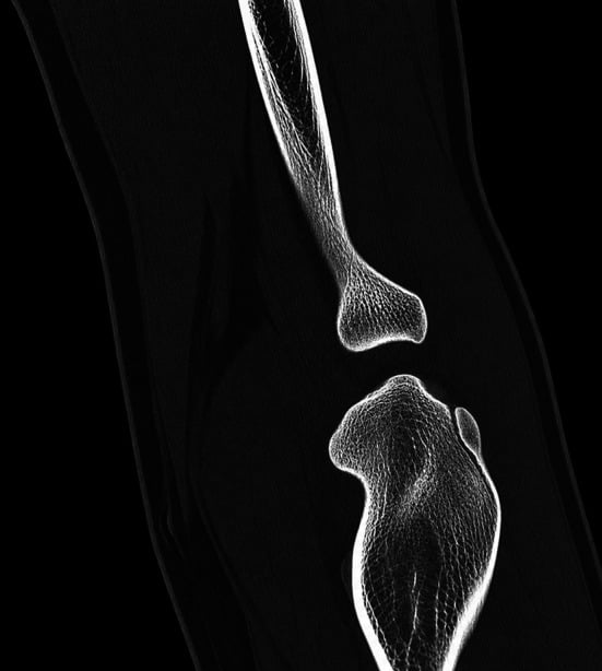 Three-month postoperative CT showing osseous consolidation of the capitellar fragment with restored articular congruity