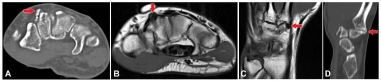 Multimodal CT and MRI imaging of a carpal boss showing the dorsal metacarpal base protuberance