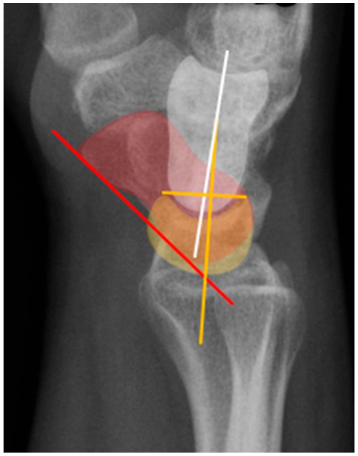 Carpal alignment and angle measurements on lateral wrist radiograph