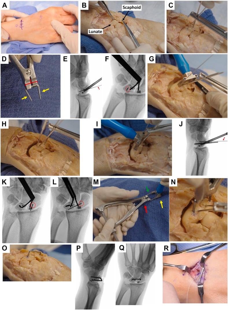 Stepwise operative and fluoroscopic montage of dorsal scapholunate reduction, repair and temporary staple fixation.