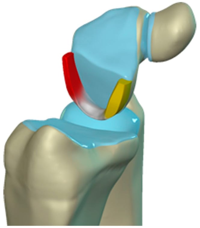 Three-dimensional illustration of the dorsal, proximal membranous and volar components of the lunotriquetral ligament.
