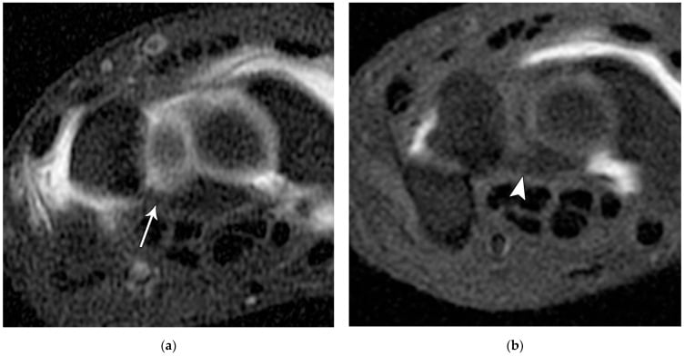 Axial fat-suppressed MR arthrograms showing the normal thick volar lunotriquetral ligament fibres.